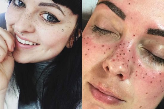 People Are Tattooing On Freckles No Joke Komo | people are tattooing on freckles no joke komo People Are Tattooing On Freckles No Joke Komo | people are tattooing on freckles no joke komo