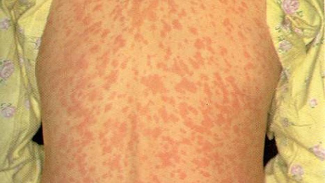 Kern health officials warn of measles exposure at Taco Bell