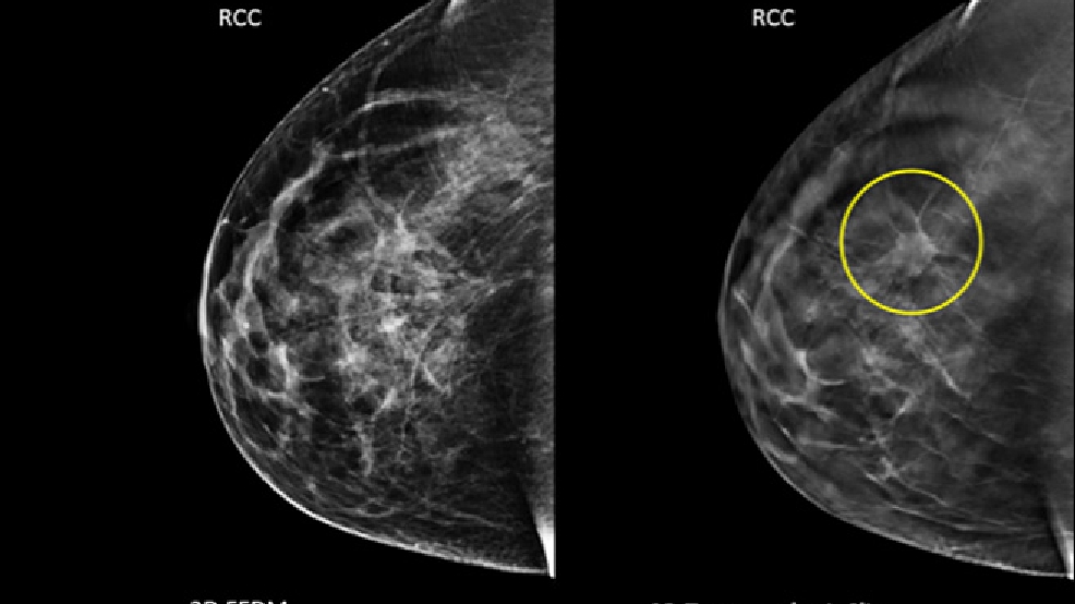 Banner Churchill Adds 3d Technology For Mammograms Krnv