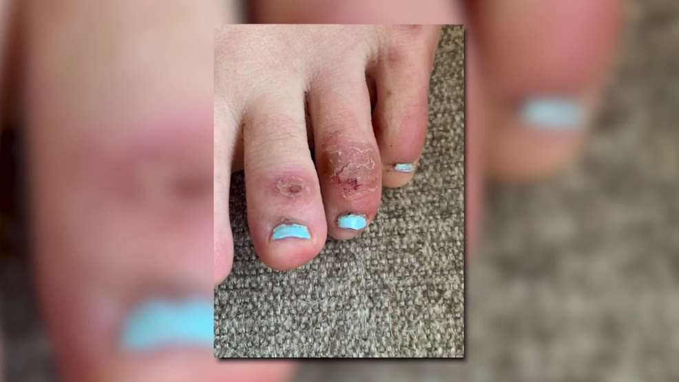 Doctors say 'COVID Toes' could be a new symptom of the coronavirus WGME