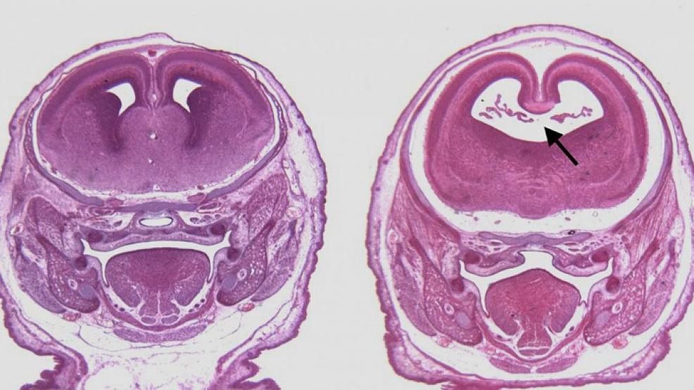 exposure to marijuana during pregnancy can cause birth defects WEYI