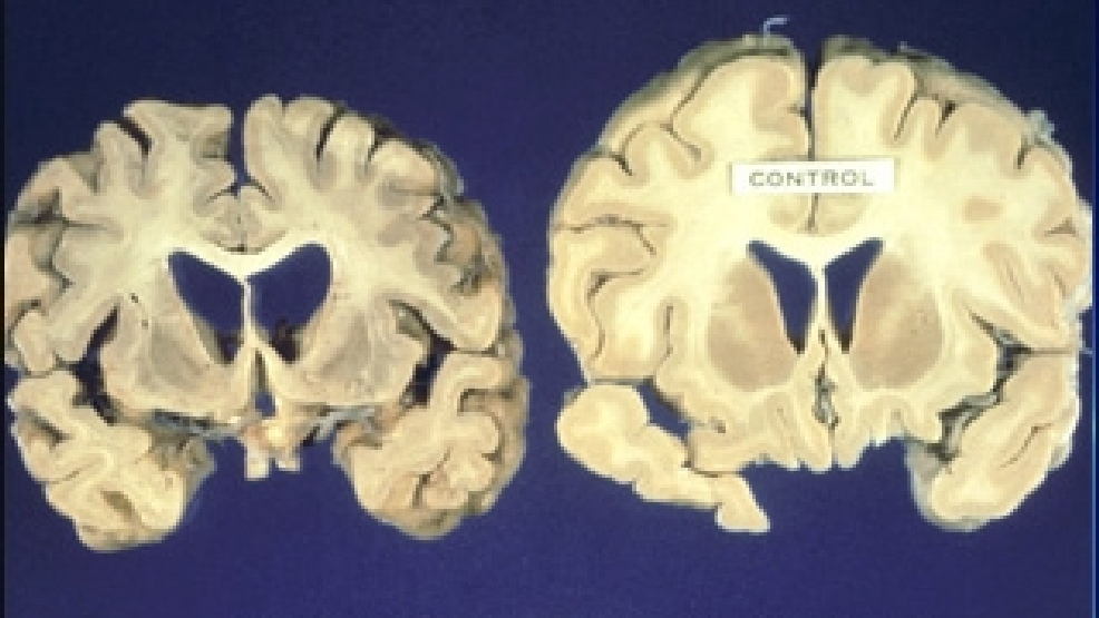 massachusetts-patient-tested-for-mad-cow-disease-kval